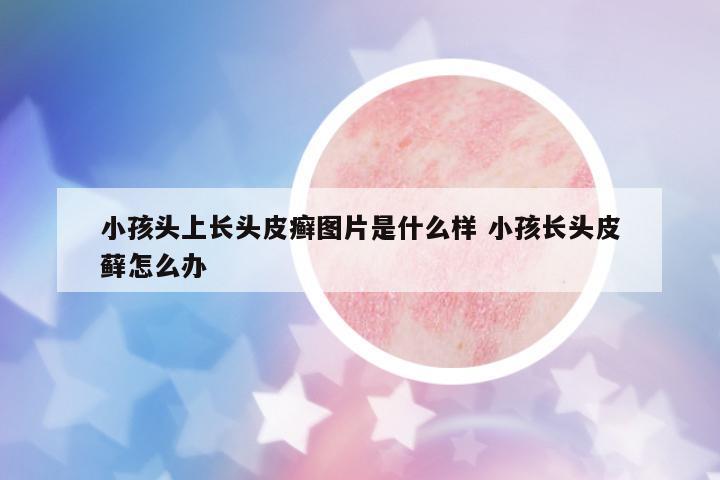 小孩頭上長頭皮癬圖片是什么樣 小孩長頭皮蘚怎么辦