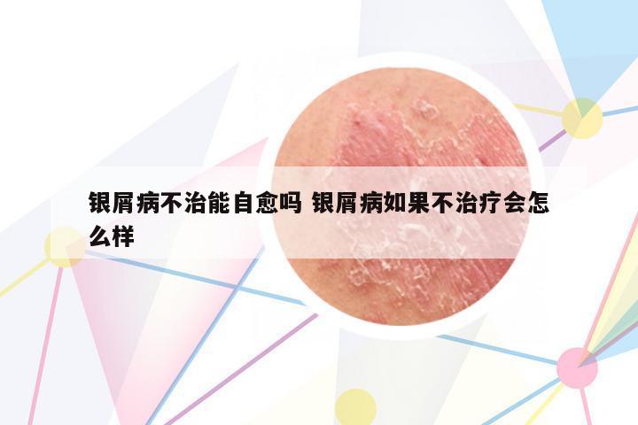 銀屑病不治能自愈嗎 銀屑病如果不治療會怎么樣