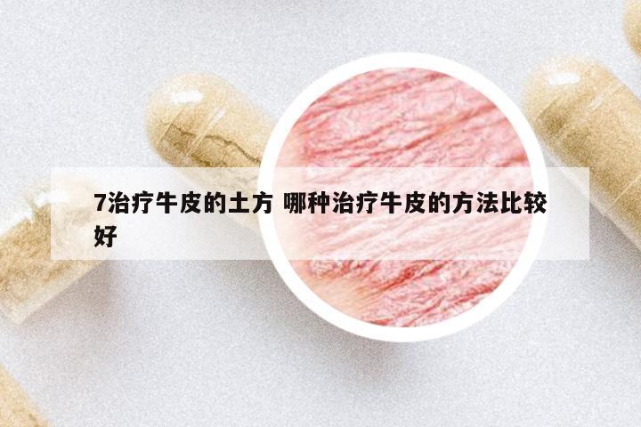 7治療牛皮的土方 哪種治療牛皮的方法比較好