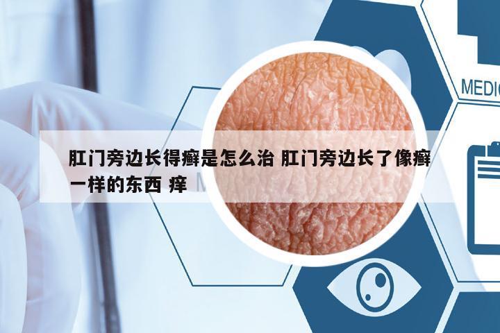 肛門旁邊長得癬是怎么治 肛門旁邊長了像癬一樣的東西 癢