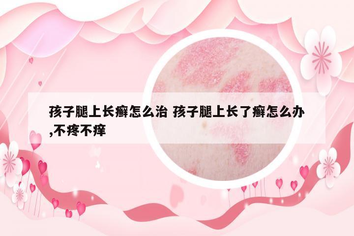孩子腿上長癬怎么治 孩子腿上長了癬怎么辦,不疼不癢