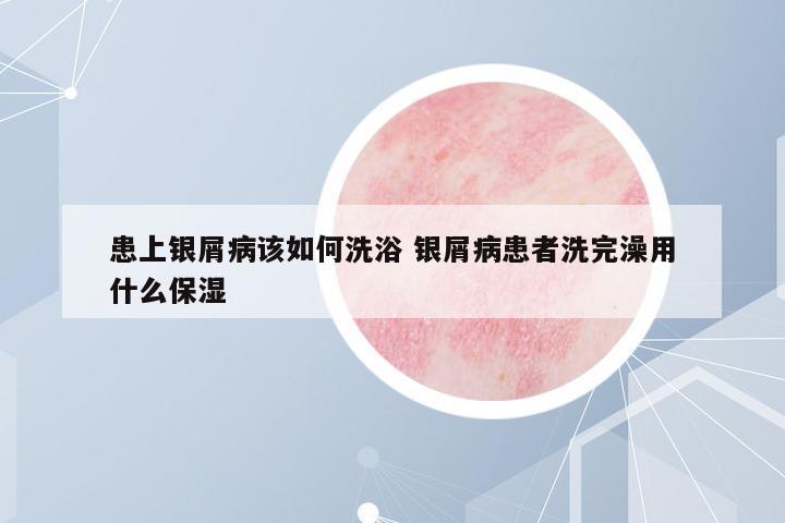 患上銀屑病該如何洗浴 銀屑病患者洗完澡用什么保濕