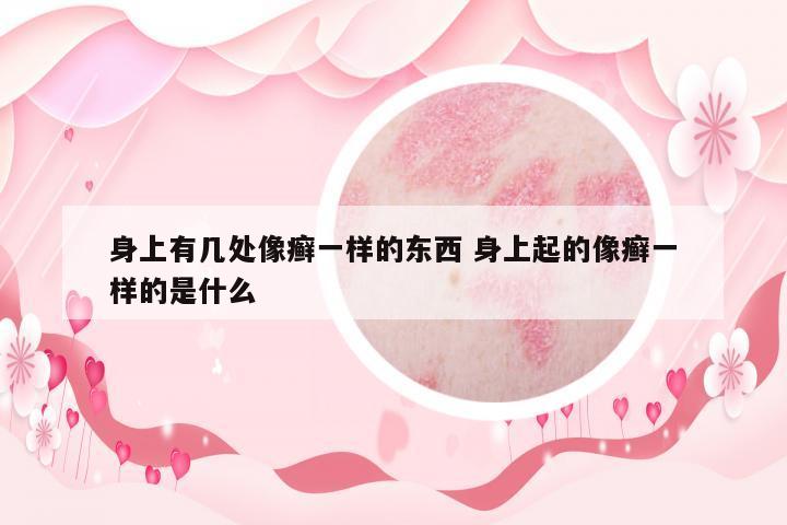 身上有幾處像癬一樣的東西 身上起的像癬一樣的是什么