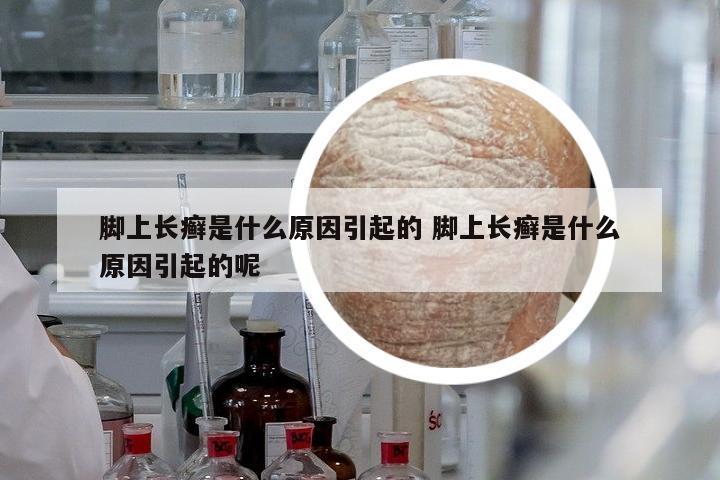 腳上長癬是什么原因引起的 腳上長癬是什么原因引起的呢