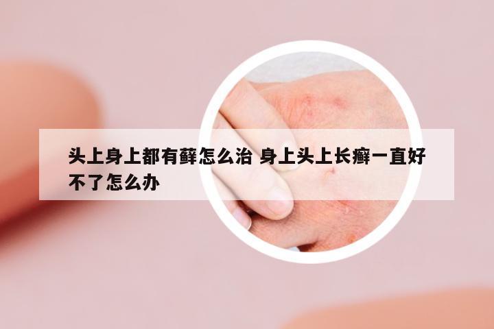頭上身上都有蘚怎么治 身上頭上長(zhǎng)癬一直好不了怎么辦