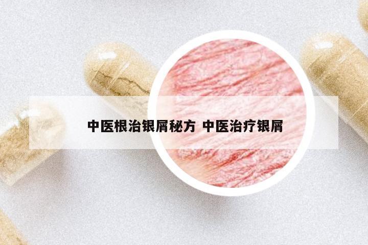 中醫(yī)根治銀屑秘方 中醫(yī)治療銀屑