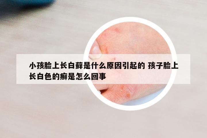 小孩臉上長白蘚是什么原因引起的 孩子臉上長白色的癬是怎么回事