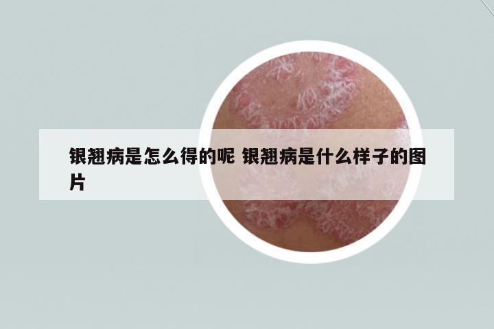 銀翹病是怎么得的呢 銀翹病是什么樣子的圖片