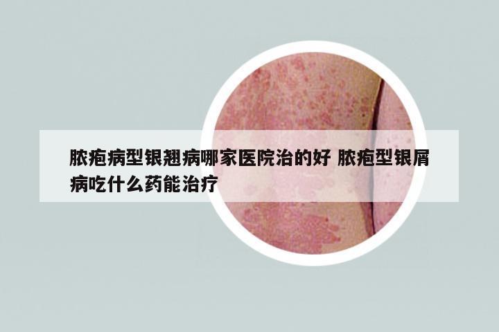 膿皰病型銀翹病哪家醫(yī)院治的好 膿皰型銀屑病吃什么藥能治療