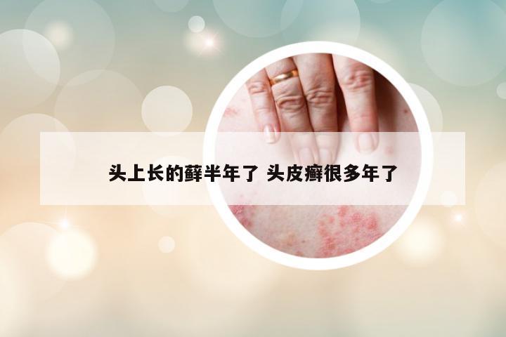 頭上長的蘚半年了 頭皮癬很多年了