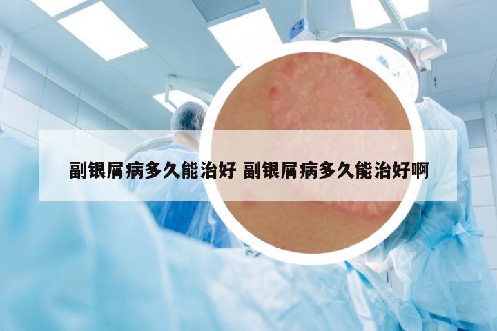 副銀屑病多久能治好 副銀屑病多久能治好啊