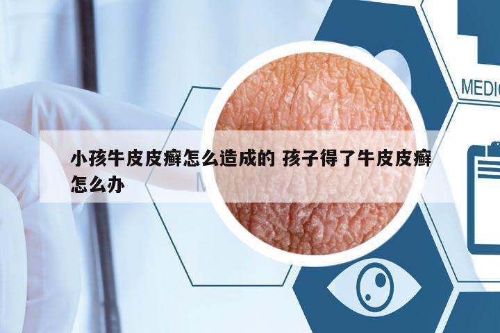 小孩牛皮皮癬怎么造成的 孩子得了牛皮皮癬怎么辦