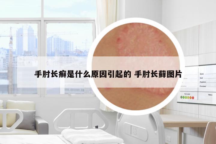 手肘長(zhǎng)癬是什么原因引起的 手肘長(zhǎng)蘚圖片