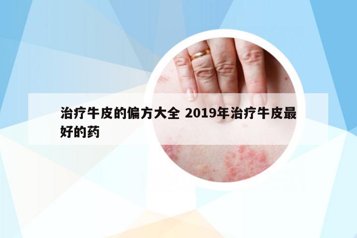 治療牛皮的偏方大全 2019年治療牛皮最好的藥