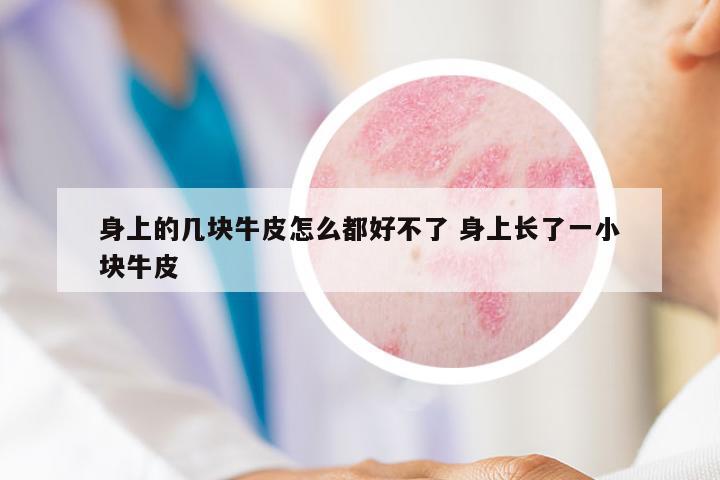 身上的幾塊牛皮怎么都好不了 身上長(zhǎng)了一小塊牛皮