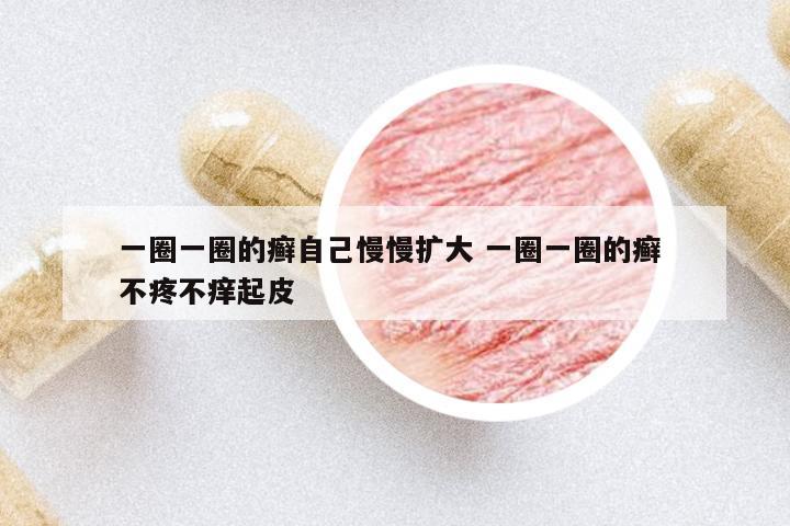 一圈一圈的癬自己慢慢擴(kuò)大 一圈一圈的癬 不疼不癢起皮