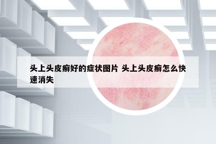 頭上頭皮癬好的癥狀圖片 頭上頭皮癬怎么快速消失