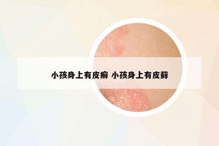 小孩身上有皮癬 小孩身上有皮蘚