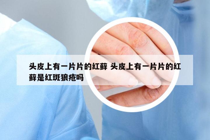頭皮上有一片片的紅蘚 頭皮上有一片片的紅蘚是紅斑狼瘡嗎