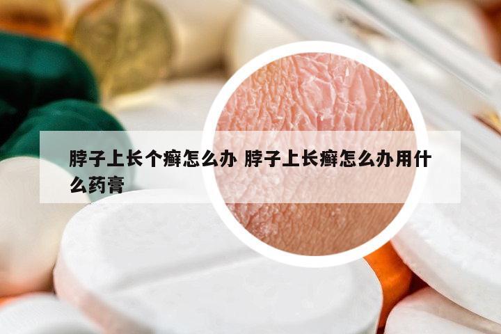 脖子上長個癬怎么辦 脖子上長癬怎么辦用什么藥膏