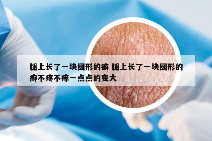 腿上長了一塊圓形的癬 腿上長了一塊圓形的癬不疼不癢一點點的變大