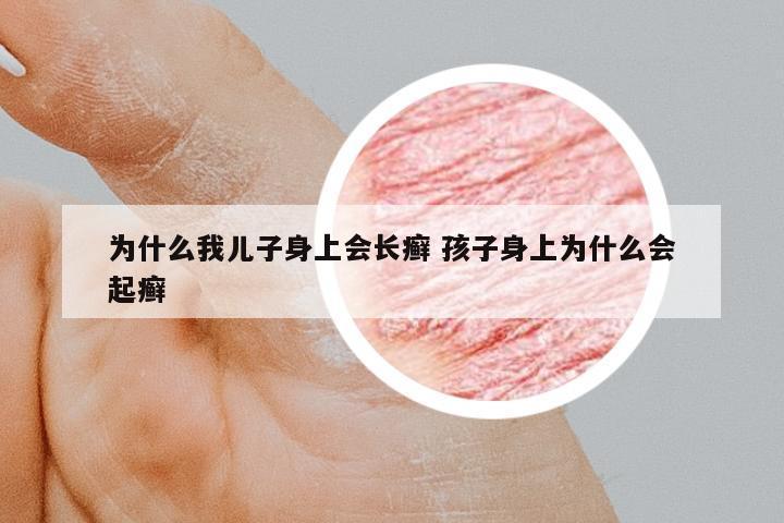 為什么我兒子身上會長癬 孩子身上為什么會起癬