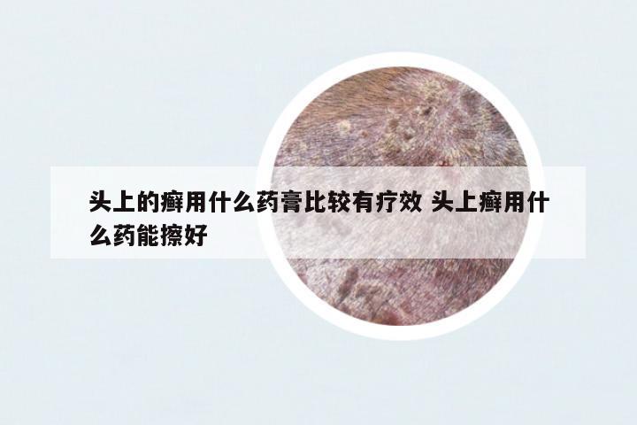 頭上的癬用什么藥膏比較有療效 頭上癬用什么藥能擦好