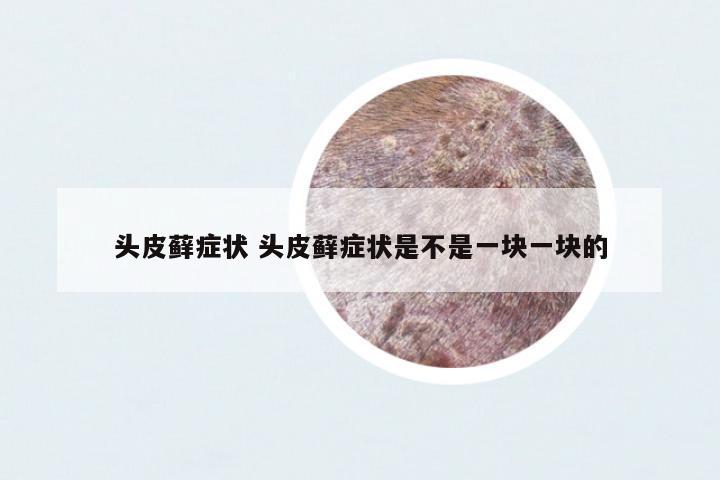頭皮蘚癥狀 頭皮蘚癥狀是不是一塊一塊的