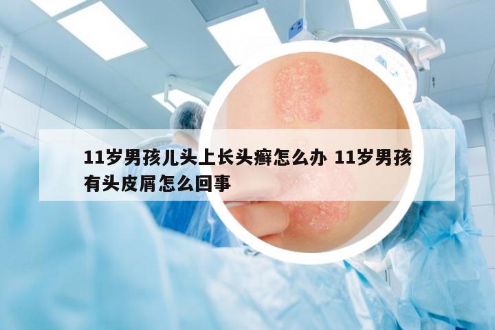 11歲男孩兒頭上長(zhǎng)頭癬怎么辦 11歲男孩有頭皮屑怎么回事