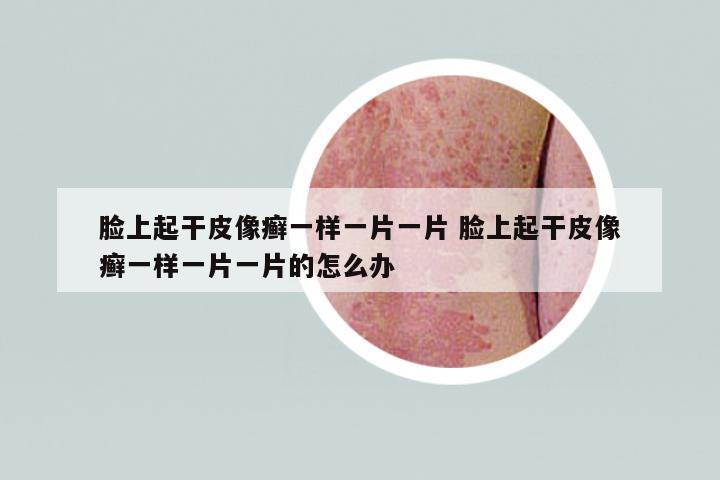 臉上起干皮像癬一樣一片一片 臉上起干皮像癬一樣一片一片的怎么辦