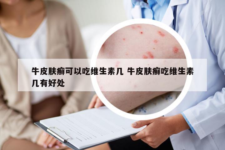 牛皮膚癬可以吃維生素幾 牛皮膚癬吃維生素幾有好處