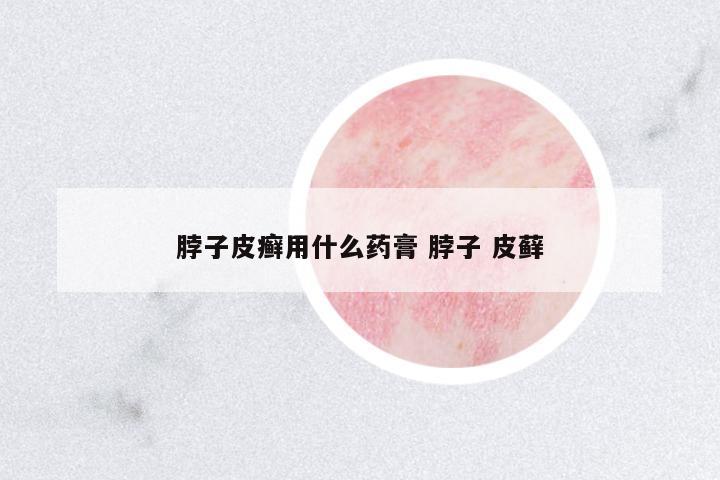 脖子皮癬用什么藥膏 脖子 皮蘚