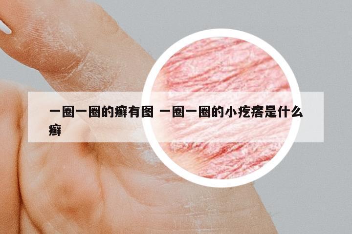 一圈一圈的癬有圖 一圈一圈的小疙瘩是什么癬