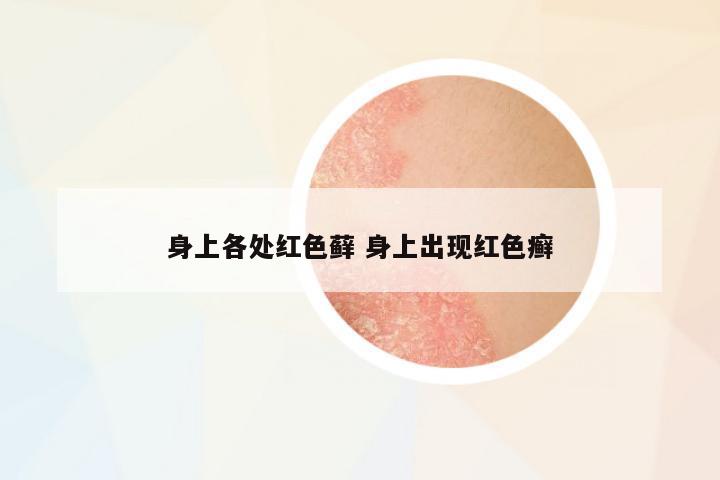 身上各處紅色蘚 身上出現(xiàn)紅色癬