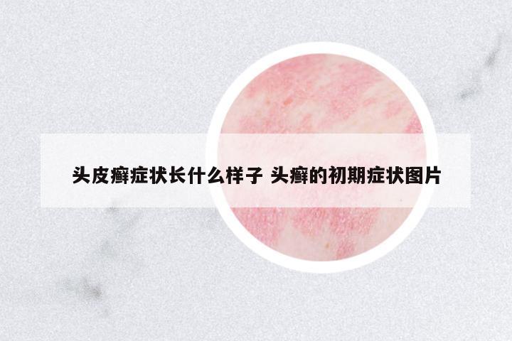 頭皮癬癥狀長什么樣子 頭癬的初期癥狀圖片
