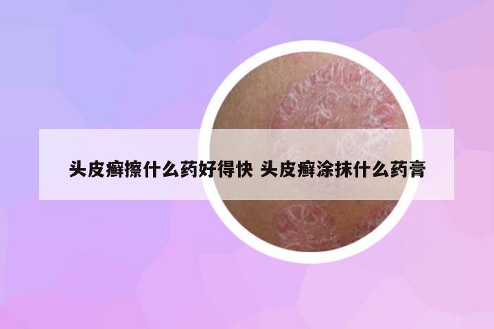 頭皮癬擦什么藥好得快 頭皮癬涂抹什么藥膏