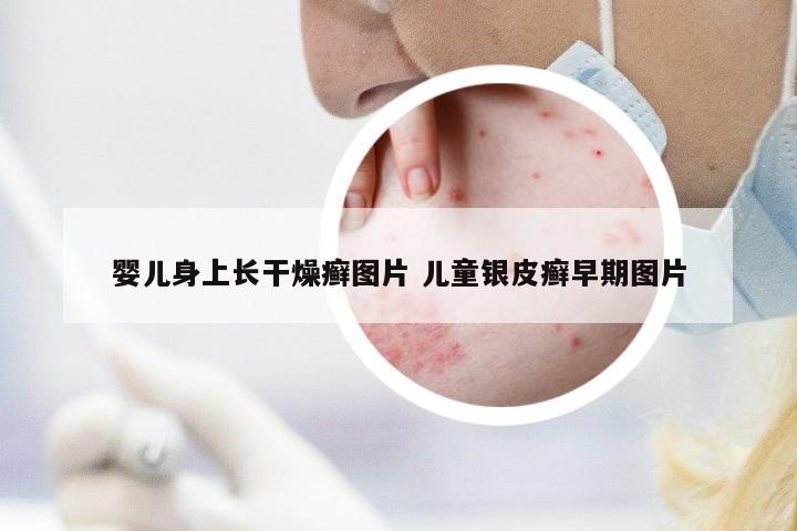 嬰兒身上長干燥癬圖片 兒童銀皮癬早期圖片