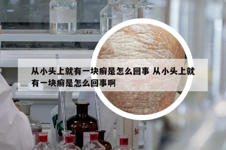從小頭上就有一塊癬是怎么回事 從小頭上就有一塊癬是怎么回事啊