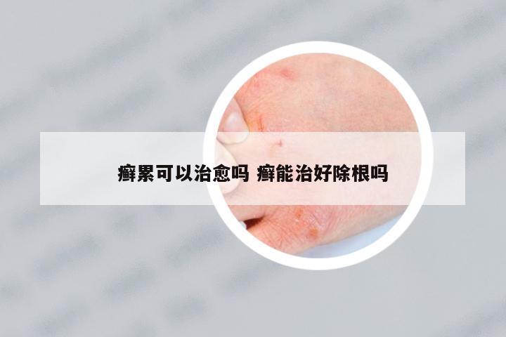癬累可以治愈嗎 癬能治好除根嗎