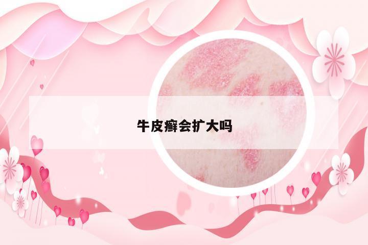 牛皮癬會(huì)擴(kuò)大嗎