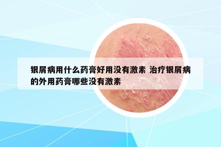 銀屑病用什么藥膏好用沒(méi)有激素 治療銀屑病的外用藥膏哪些沒(méi)有激素