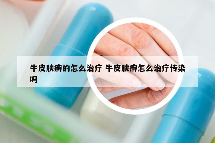 牛皮膚癬的怎么治療 牛皮膚癬怎么治療傳染嗎