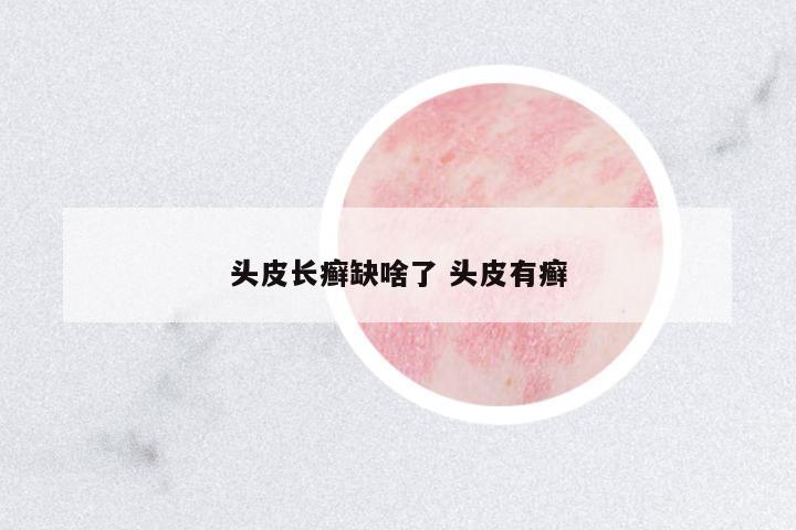 頭皮長癬缺啥了 頭皮有癬