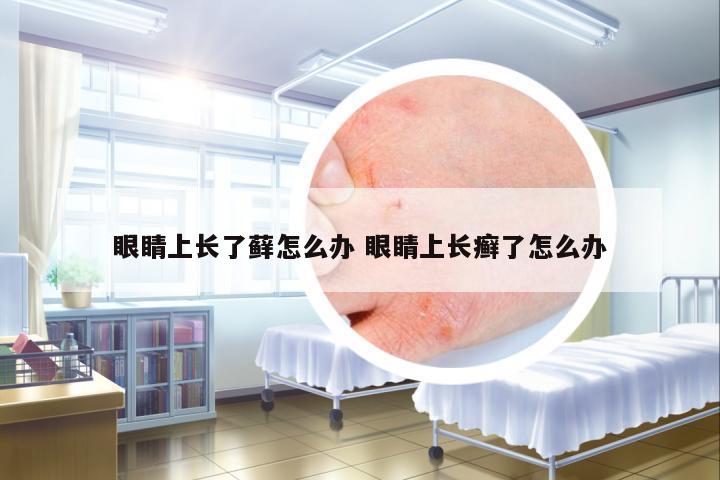 眼睛上長(zhǎng)了蘚怎么辦 眼睛上長(zhǎng)癬了怎么辦