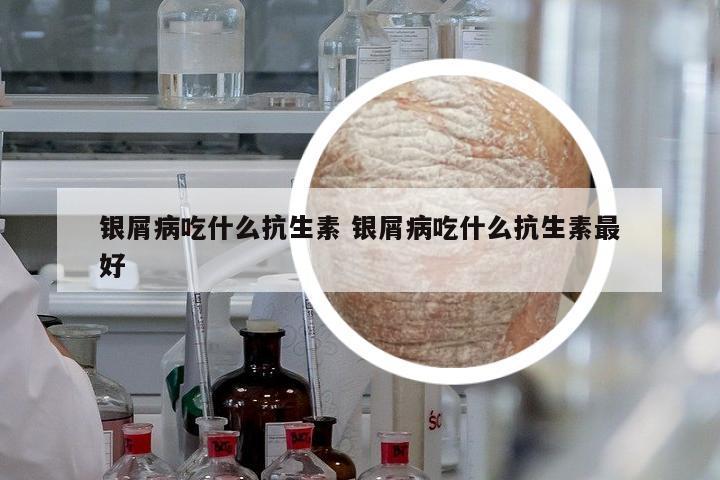銀屑病吃什么抗生素 銀屑病吃什么抗生素最好