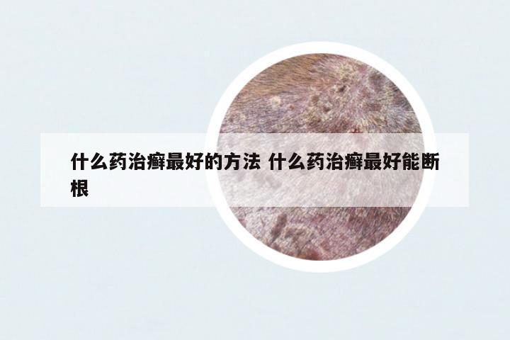 什么藥治癬最好的方法 什么藥治癬最好能斷根