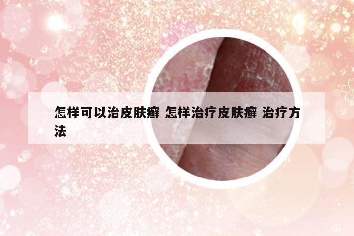 怎樣可以治皮膚癬 怎樣治療皮膚癬 治療方法