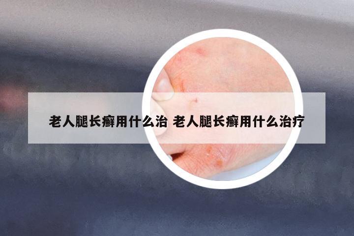 老人腿長癬用什么治 老人腿長癬用什么治療