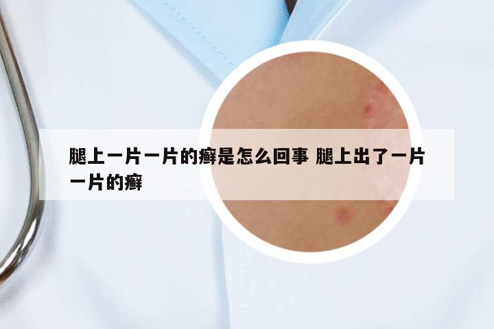 腿上一片一片的癬是怎么回事 腿上出了一片一片的癬