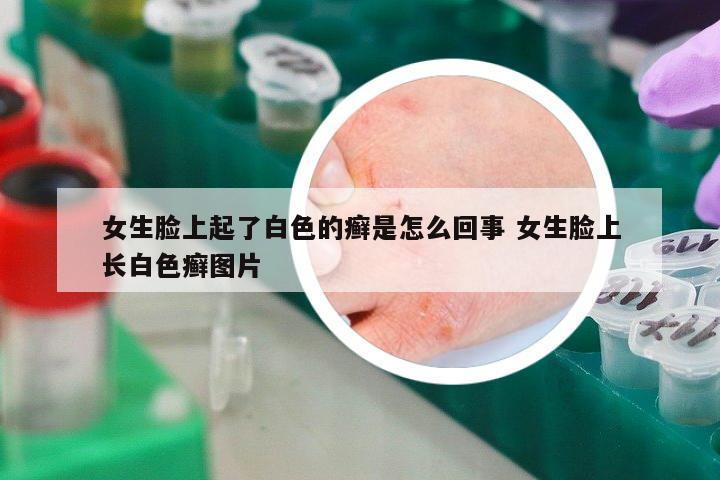 女生臉上起了白色的癬是怎么回事 女生臉上長(zhǎng)白色癬圖片